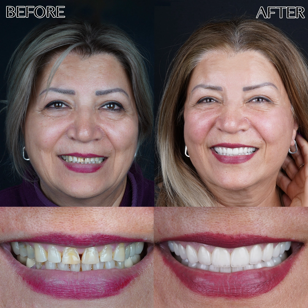 Full dental veneers in Turkey