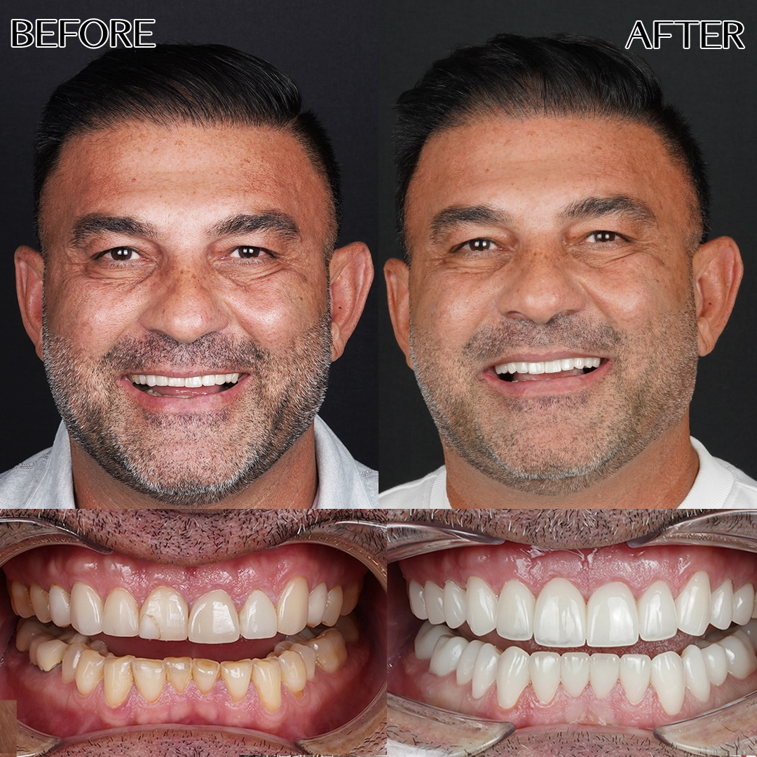 Emax crowns in IStanbul