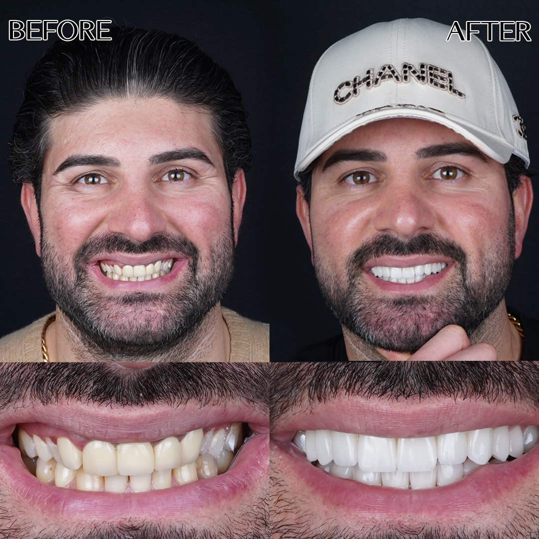 Dental crowns in Istanbul