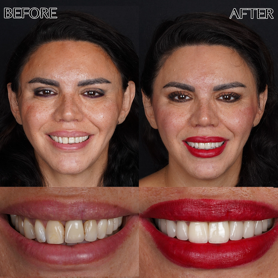 Dental laminate veneers in Istanbul