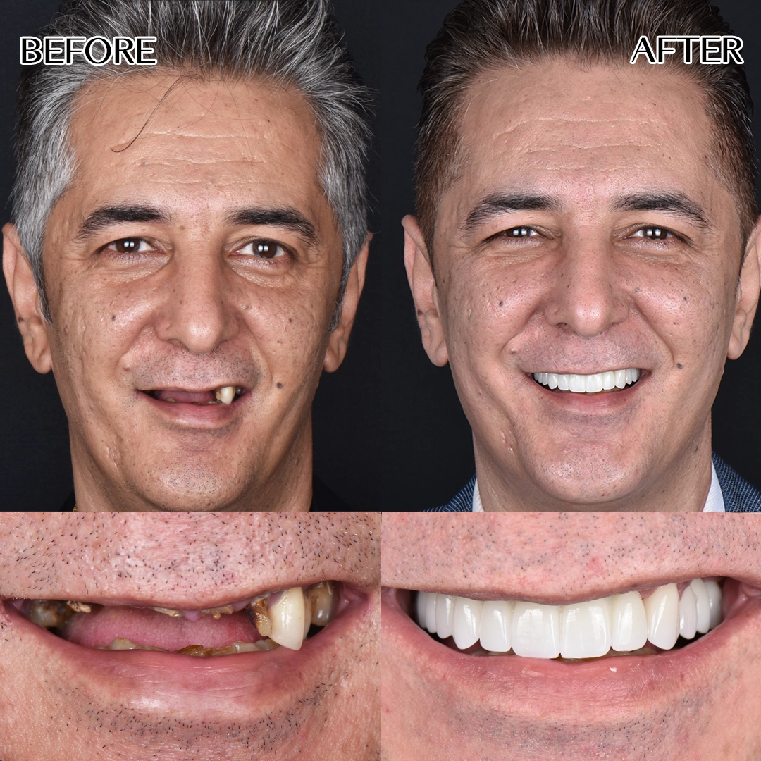 All on 6 dental implants in Istanbul